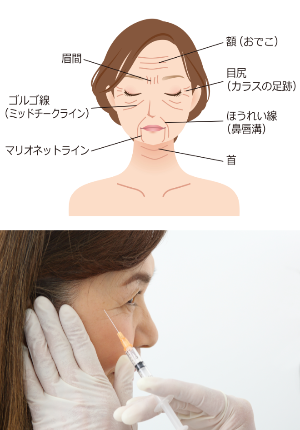 しみ・しわ・ヒアルロン酸注射