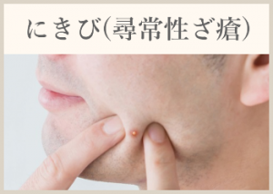 にきび(尋常性ざ瘡)