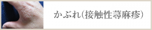 かぶれ(接触性蕁麻疹)