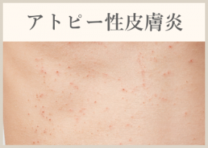 アトピー性皮膚炎