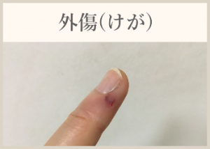 外傷(けが)