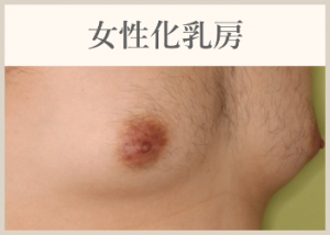 女性化乳房
