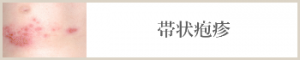 帯状疱疹