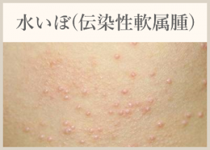 水いぼ(伝染性軟属腫)