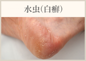 水虫(白癬)