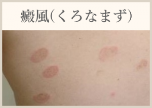 癜風(くろなまず)