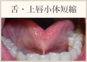 舌・上唇小体短縮