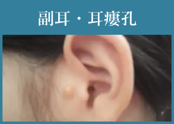 副耳・耳瘻孔