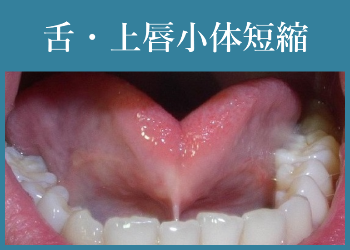 舌・上唇小体短縮