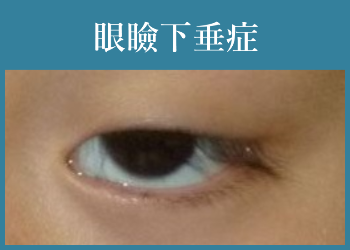 眼瞼下垂症