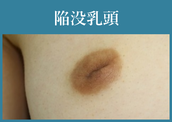 陥没乳頭