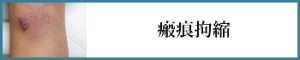 瘢痕拘縮