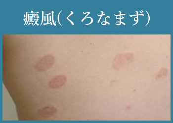 癜風(くろなまず)