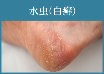 水虫(白癬)