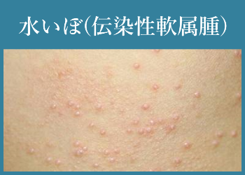 水いぼ(伝染性軟属腫)