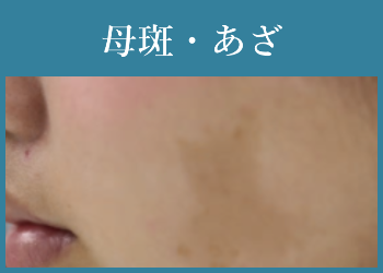 母斑・あざ