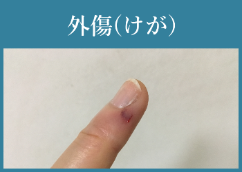 外傷(けが)
