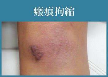 瘢痕拘縮