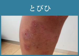 とびひ