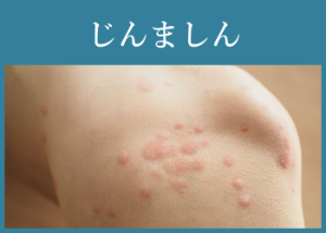 じんましん