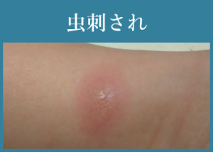 虫刺され