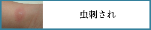 虫刺され