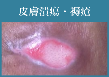 皮膚潰瘍・褥瘡