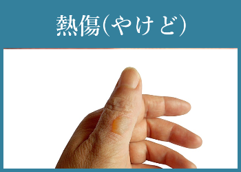 熱傷(やけど)