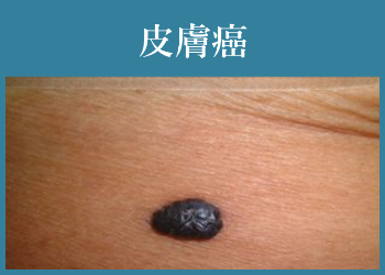 皮膚癌