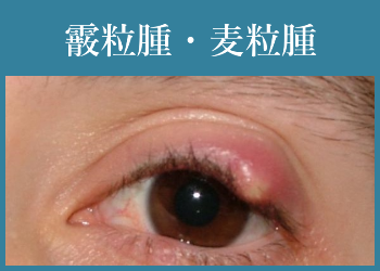 霰粒腫・麦粒腫