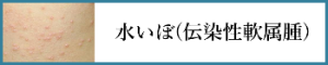 水いぼ(伝染性軟属腫)